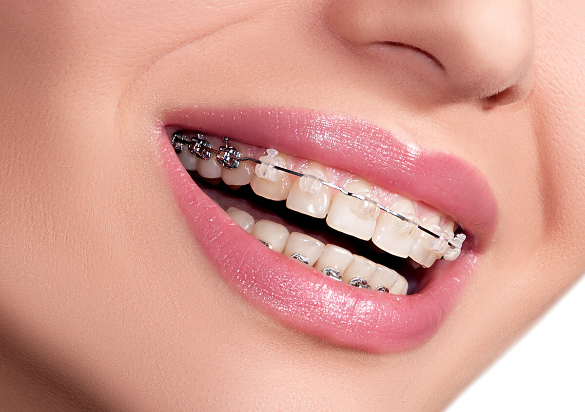 Straighten your teeth with our top-notch orthodontic services