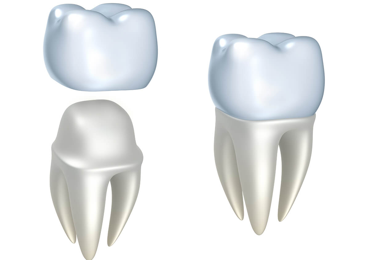 Restore your smile with natural-looking Porcelain Dental Crowns